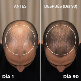 Redroott · Gorra de Terapia de Luz Roja para Crecimiento Capilar 7
